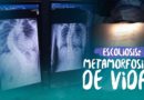 Nicaragua se convierte en el primer país en realizar cirugías de escoliosis gratis