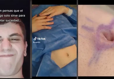 ombligo, argentino, hombre, joven, cirugía, plástica, quiita, quitarse, acumular, suciedad, tiktok, redes,