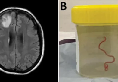 gusano, parásito, extraen vivo, con vida, cerebro, mujer, primer caso, mundo, humanos, registrado, Australia, Ophidascaris robertsi, pitón, serpiente, cirugía, operación, especialistas,