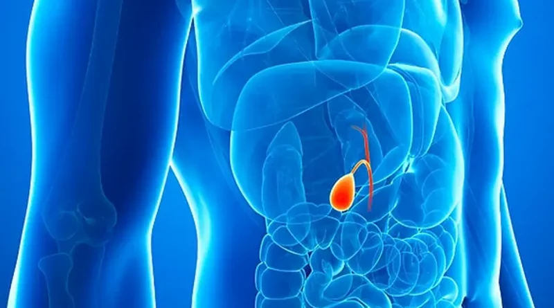 operación, cirugia, laparoscopica, colelitiasis, piedra en la vesícula, tratamiento, cálculos,