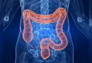 pólipos, cáncer, colon, desarrollo, prevenir, salud,