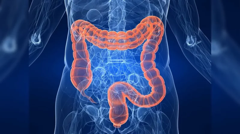 pólipos, cáncer, colon, desarrollo, prevenir, salud,